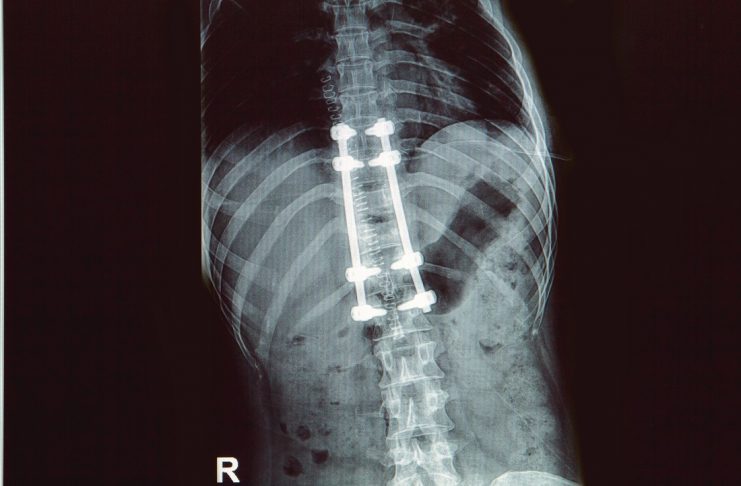 spine implant