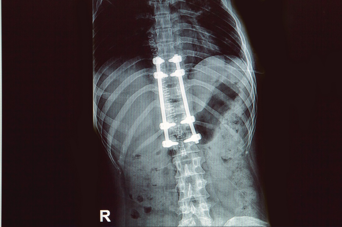 spine implant